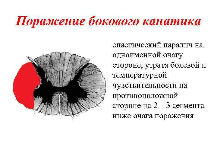 Поражение бокового канатика спастический паралич на одноименной очагу стороне, утрата болевой и температурной чувствительности