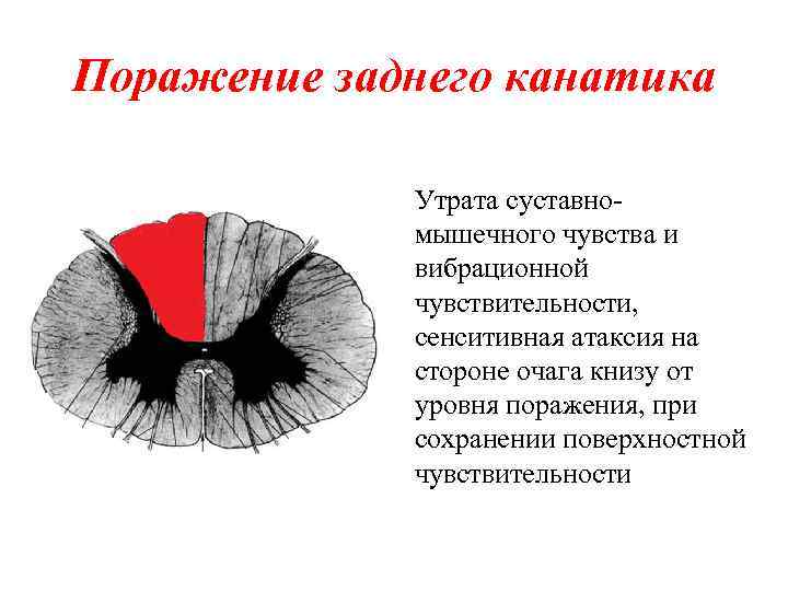 Поражение заднего канатика Утрата суставномышечного чувства и вибрационной чувствительности, сенситивная атаксия на стороне очага