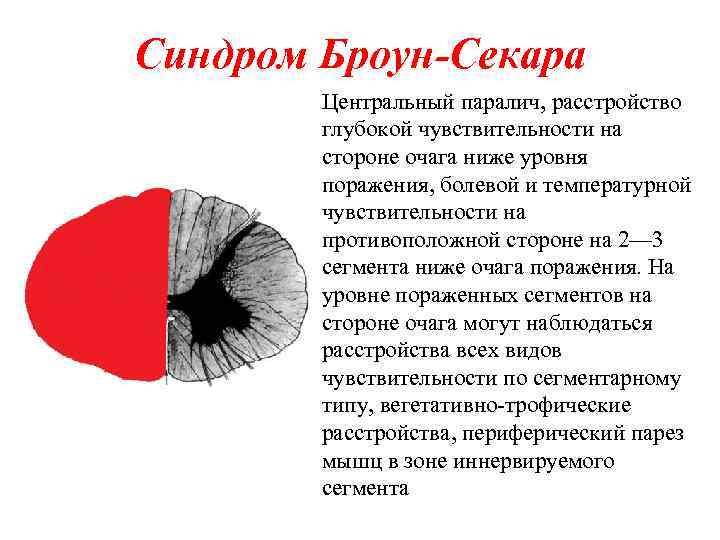 Синдром Броун-Секара Центральный паралич, расстройство глубокой чувствительности на стороне очага ниже уровня поражения, болевой