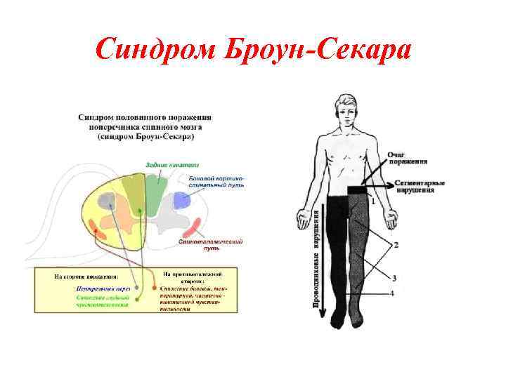 Синдром Броун-Секара 