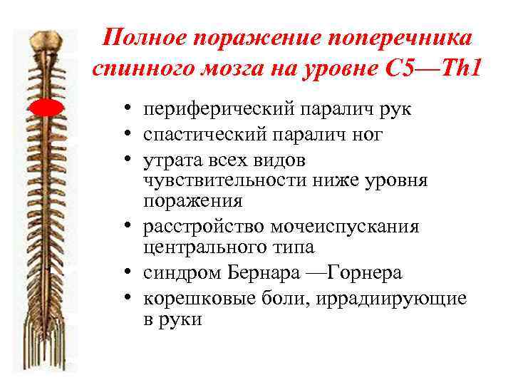 Полное поражение поперечника спинного мозга на уровне С 5—Th 1 • периферический паралич рук