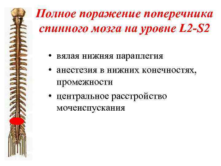Полное поражение поперечника спинного мозга на уровне L 2 -S 2 • вялая нижняя