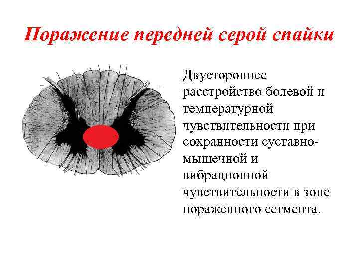 Поражение передней серой спайки Двустороннее расстройство болевой и температурной чувствительности при сохранности суставномышечной и