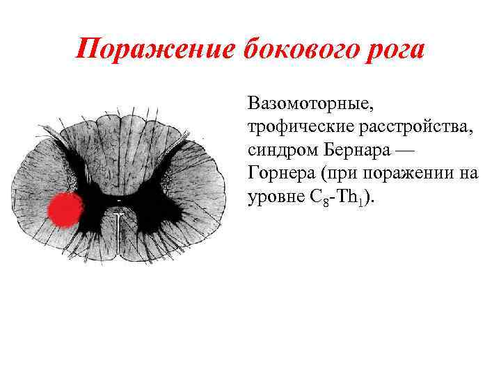 Поражение бокового рога Вазомоторные, трофические расстройства, синдром Бернара — Горнера (при поражении на уровне