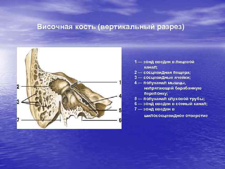 Височная кость (вертикальный разрез) 1 — зонд введен в лицевой канал; 2 — сосцевидная