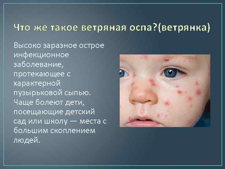 Что же такое ветряная оспа? (ветрянка) Высоко заразное острое инфекционное заболевание, протекающее с характерной