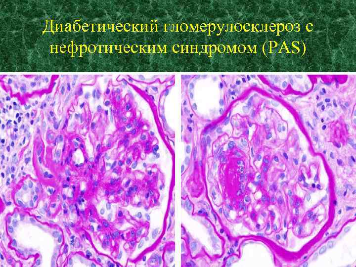 Диабетический гломерулосклероз с нефротическим синдромом (PAS) 