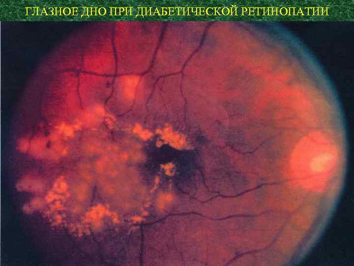 ГЛАЗНОЕ ДНО ПРИ ДИАБЕТИЧЕСКОЙ РЕТИНОПАТИИ 