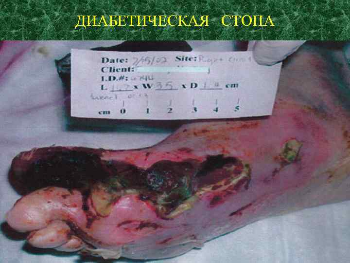 ДИАБЕТИЧЕСКАЯ СТОПА 