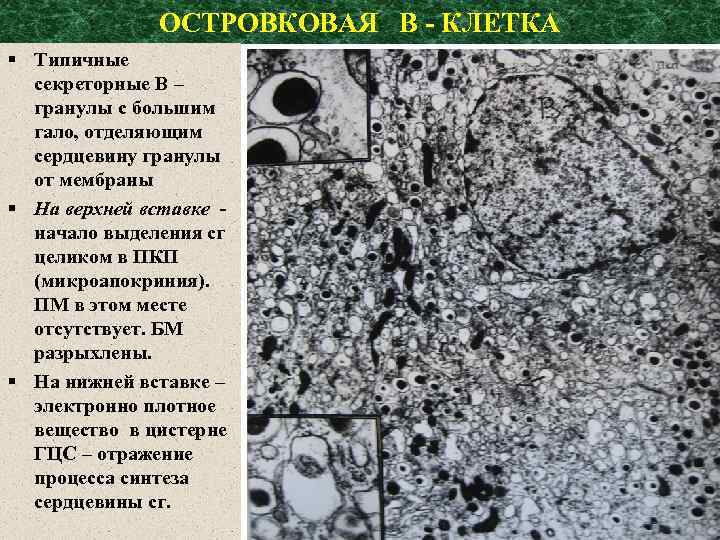 ОСТРОВКОВАЯ В - КЛЕТКА § Типичные секреторные В – гранулы с большим гало, отделяющим
