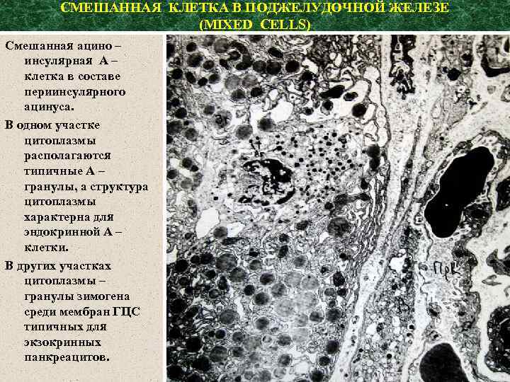 СМЕШАННАЯ КЛЕТКА В ПОДЖЕЛУДОЧНОЙ ЖЕЛЕЗЕ (MIXED CELLS) Смешанная ацино – инсулярная А – клетка