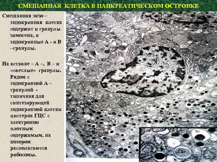 СМЕШАННАЯ КЛЕТКА В ПАНКРЕАТИЧЕСКОМ ОСТРОВКЕ Смешанная экзо – эндокринная клетка содержит и гранулы зимогена,