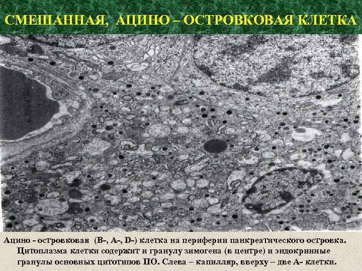 СМЕШАННАЯ, АЦИНО – ОСТРОВКОВАЯ КЛЕТКА Ацино - островковая (В-, А-, D-) клетка на периферии