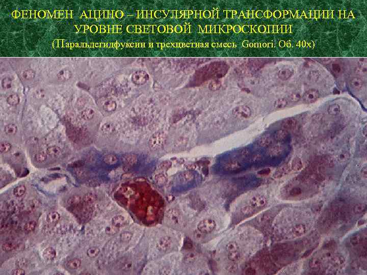 ФЕНОМЕН АЦИНО – ИНСУЛЯРНОЙ ТРАНСФОРМАЦИИ НА УРОВНЕ СВЕТОВОЙ МИКРОСКОПИИ (Паральдегидфуксин и трехцветная смесь Gomori.