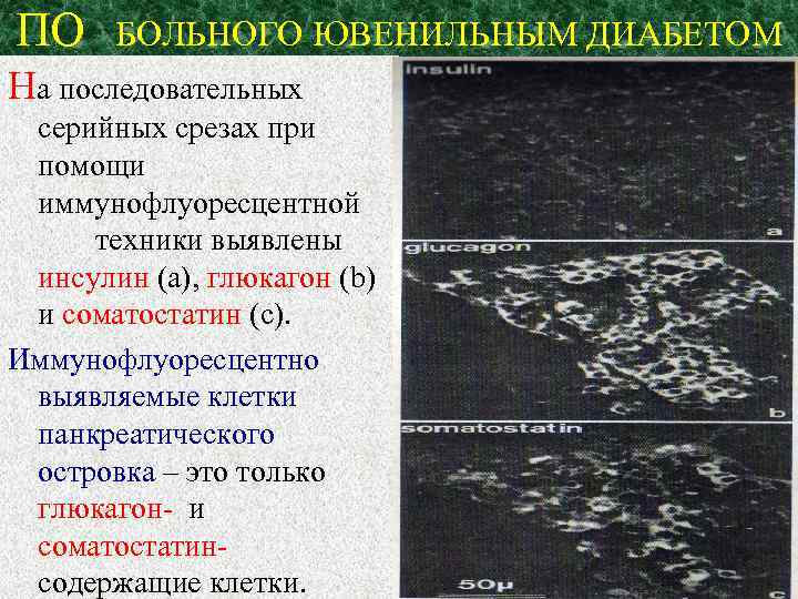 ПО БОЛЬНОГО ЮВЕНИЛЬНЫМ ДИАБЕТОМ На последовательных серийных срезах при помощи иммунофлуоресцентной техники выявлены инсулин