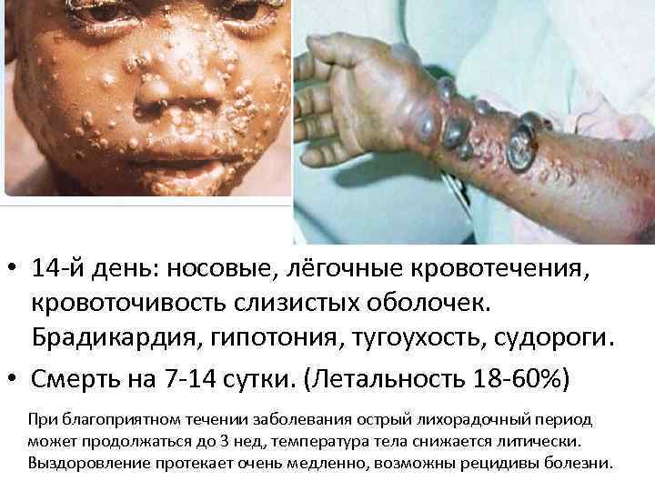  • 14 -й день: носовые, лёгочные кровотечения, кровоточивость слизистых оболочек. Брадикардия, гипотония, тугоухость,