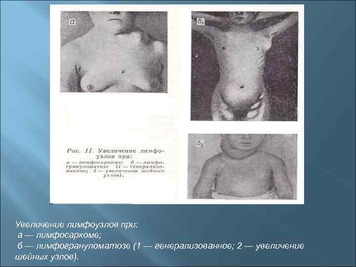 Увеличение лимфоузлов при: а — лимфосаркоме; б — лимфогрануломатозе (1 — генерализованное; 2 —