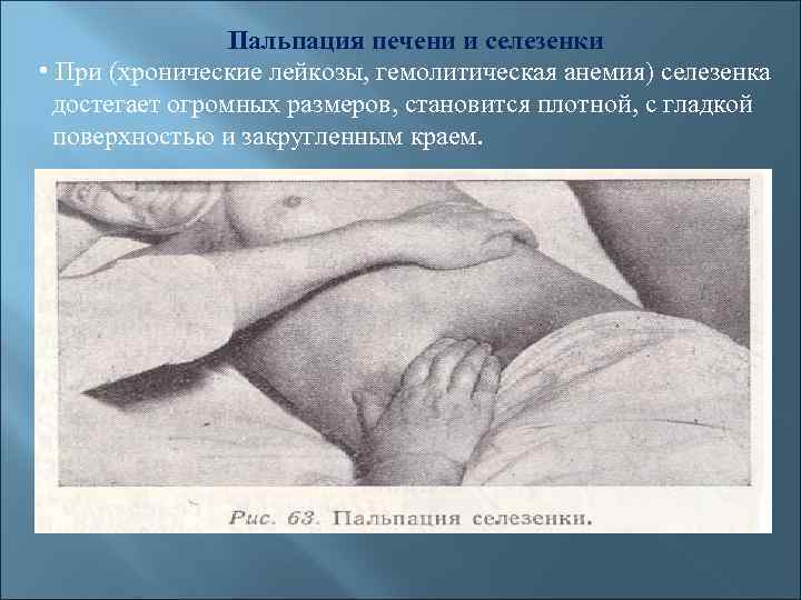 Пальпация печени и селезенки • При (хронические лейкозы, гемолитическая анемия) селезенка достегает огромных размеров,
