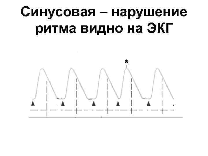 Синусовая – нарушение ритма видно на ЭКГ 