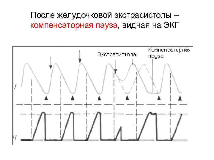 После желудочковой экстрасистолы – компенсаторная пауза, видная на ЭКГ 