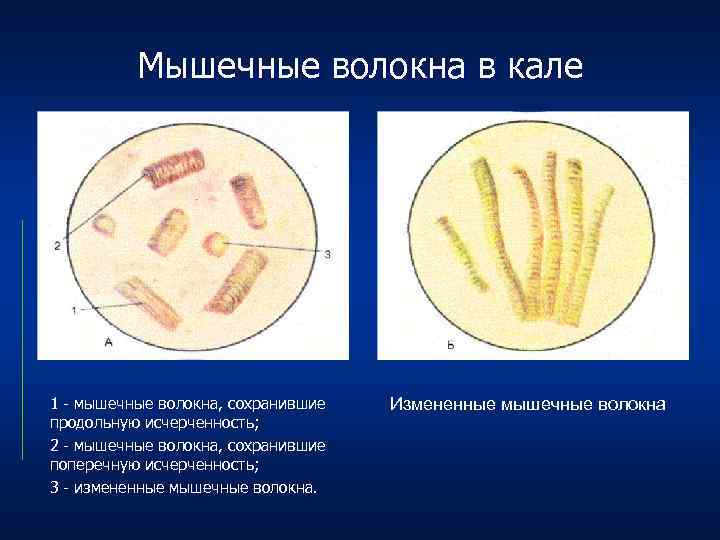 Растительная клетчатка неперевариваемая в кале у взрослого. Непереваренные мышечные волокна в Кале. Соединительная ткань в микроскопии кала. Микроскопия кала мышечные волокна. Копрограмма мышечные волокна.