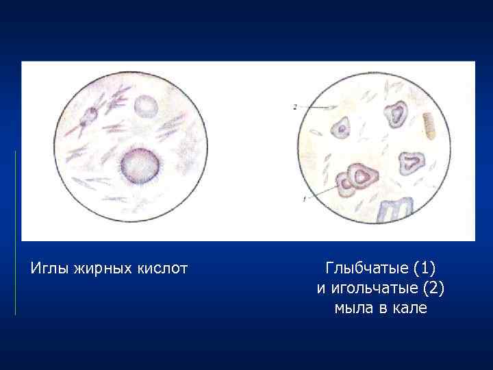 Желчные кислоты в кале. Микроскопия кала жирные кислоты. Кристаллы жирных кислот микроскопия кала. Мыла в копрограмме.