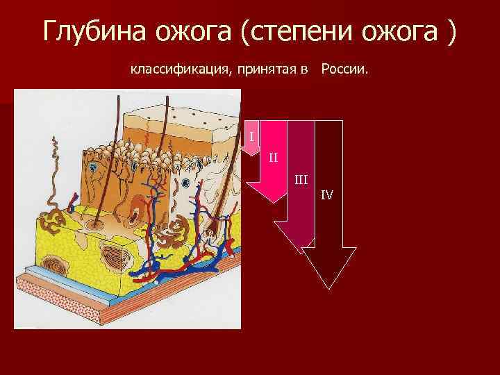 Глубина ожога (степени ожога ) классификация, принятая в России. I II IV 