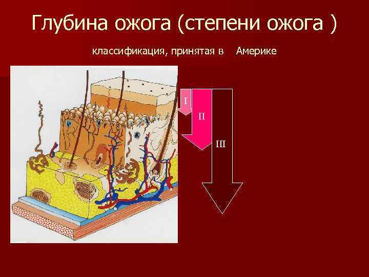 Глубина ожога (степени ожога ) классификация, принятая в I II III Америке 