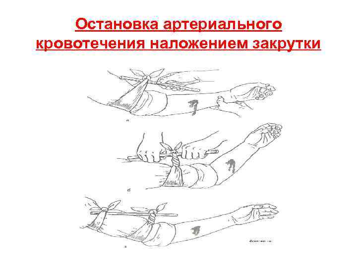 Остановка артериального кровотечения наложением закрутки 