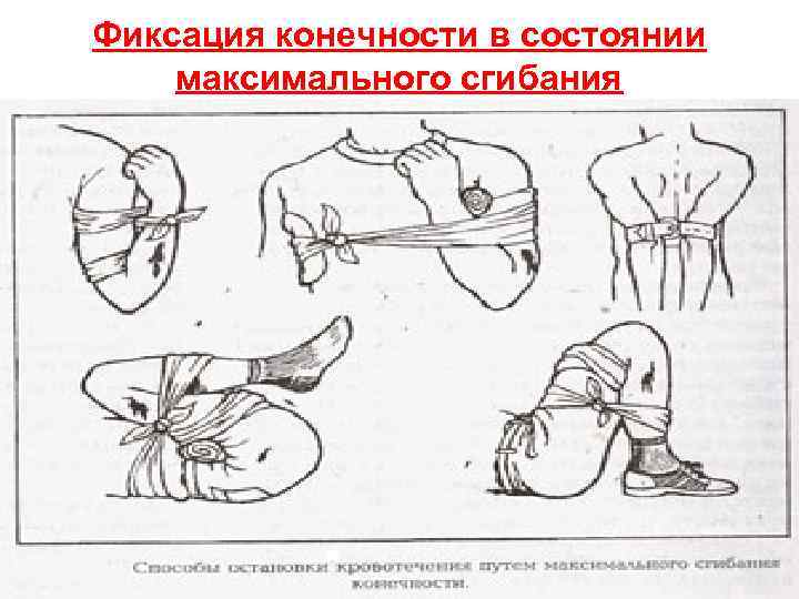 Фиксация конечности в состоянии максимального сгибания 