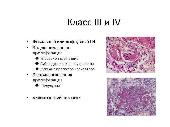 Класс III и IV • Фокальный или диффузный ГН • Эндокапиллярная пролиферация u «проволочные