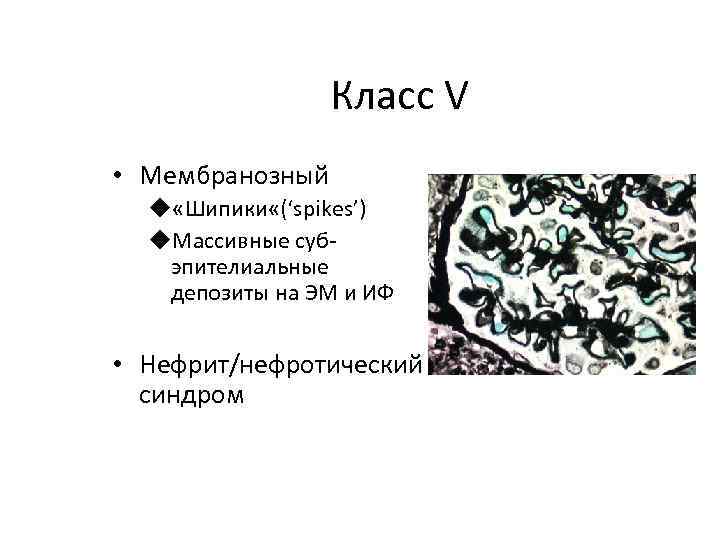 Класс V • Мембранозный u «Шипики «(‘spikes’) u. Массивные субэпителиальные депозиты на ЭМ и