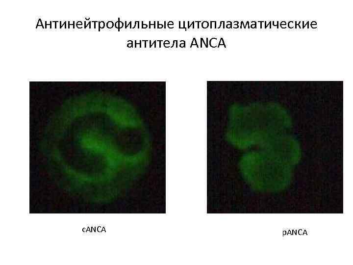 Антинейтрофильные цитоплазматические антитела ANCA c. ANCA p. ANCA 