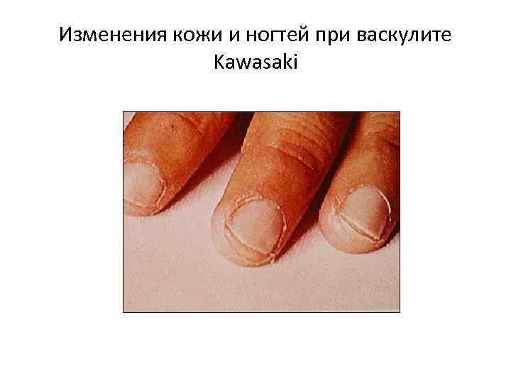 Изменения кожи и ногтей при васкулите Kawasaki 