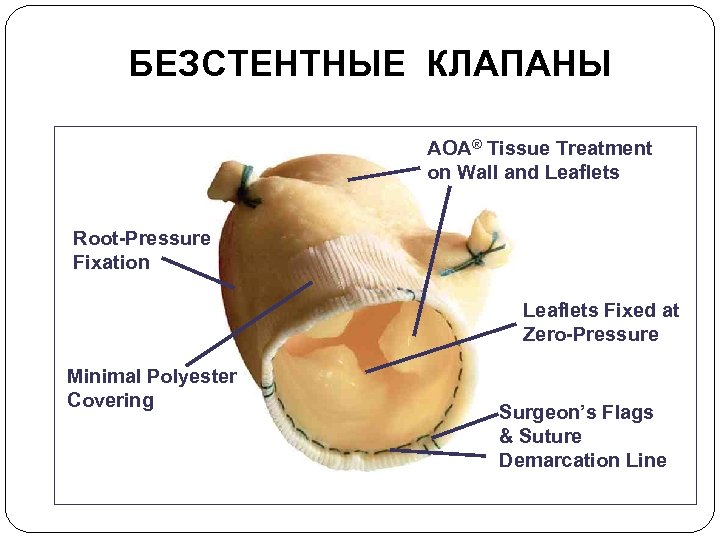 БЕЗСТЕНТНЫE КЛАПАНЫ AOA® Tissue Treatment on Wall and Leaflets Root-Pressure Fixation Leaflets Fixed at