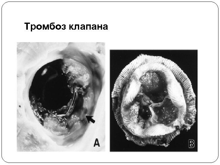Тромбоз клапана 