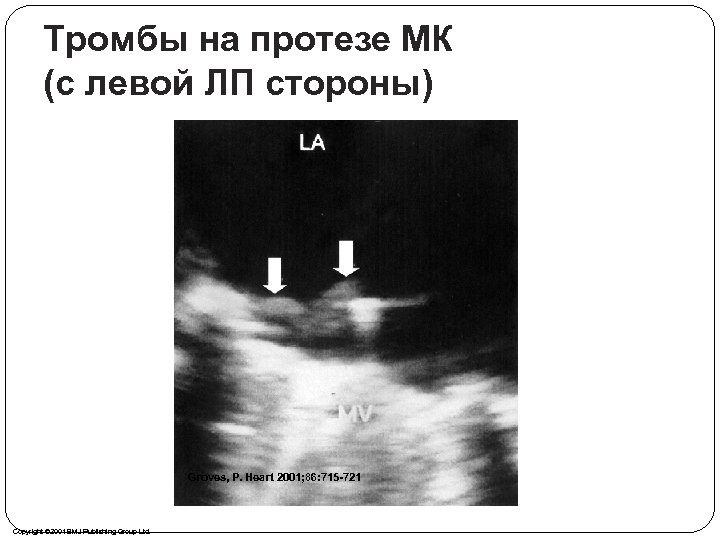 Тромбы на протезе МК (с левой ЛП стороны) Groves, P. Heart 2001; 86: 715