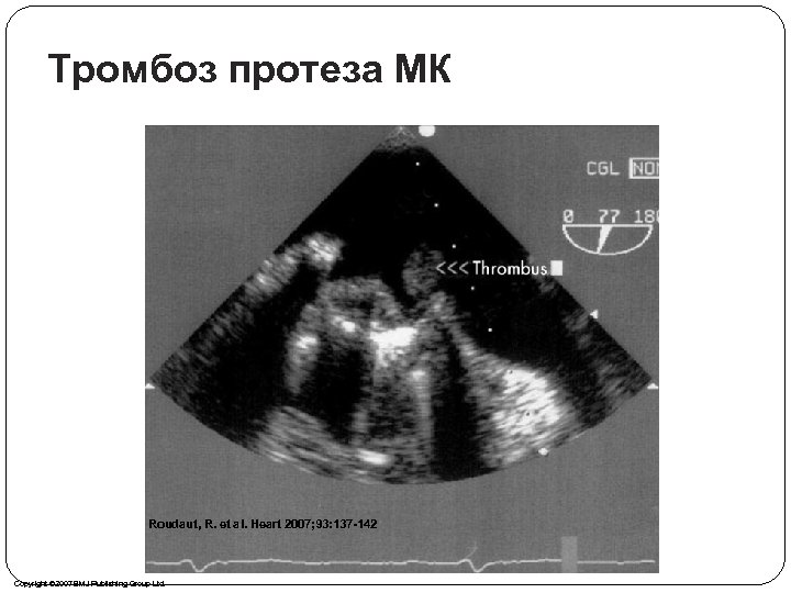 Тромбоз протеза МК Roudaut, R. et al. Heart 2007; 93: 137 -142 Copyright ©