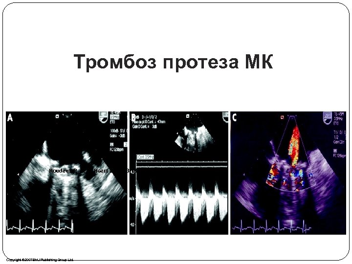 Тромбоз протеза МК Roudaut, R. et al. Heart 2007; 93: 137 -142 Copyright ©