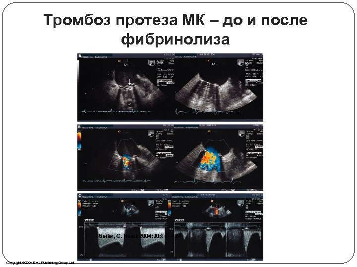 Тромбоз протеза МК – до и после фибринолиза Seiler, C. Heart 2004; 90: 818