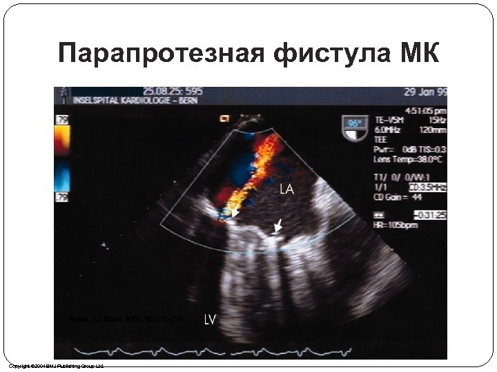 Парапротезная фистула МК Seiler, C. Heart 2004; 90: 818 -824 Copyright © 2004 BMJ