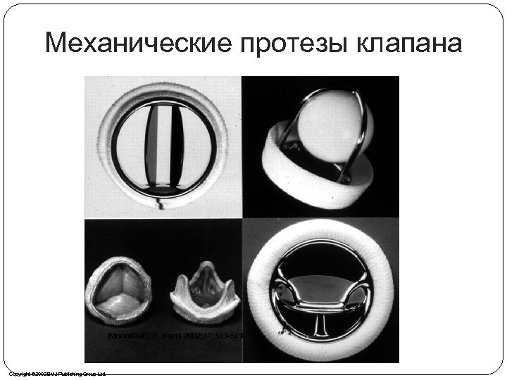 Механические протезы клапана Bloomfield, P. Heart 2002; 87: 583 -589 Copyright © 2002 BMJ