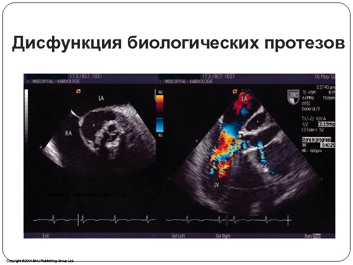 Дисфункция биологических протезов Seiler, C. Heart 2004; 90: 818 -824 Copyright © 2004 BMJ