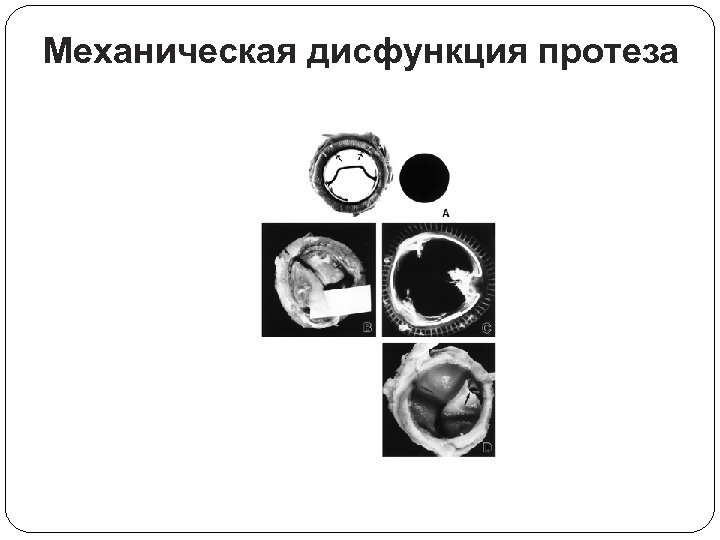 Механическая дисфункция протеза 