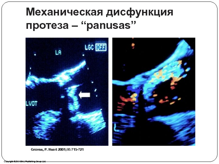 Механическая дисфункция протеза – “panusas” Groves, P. Heart 2001; 86: 715 -721 Copyright ©