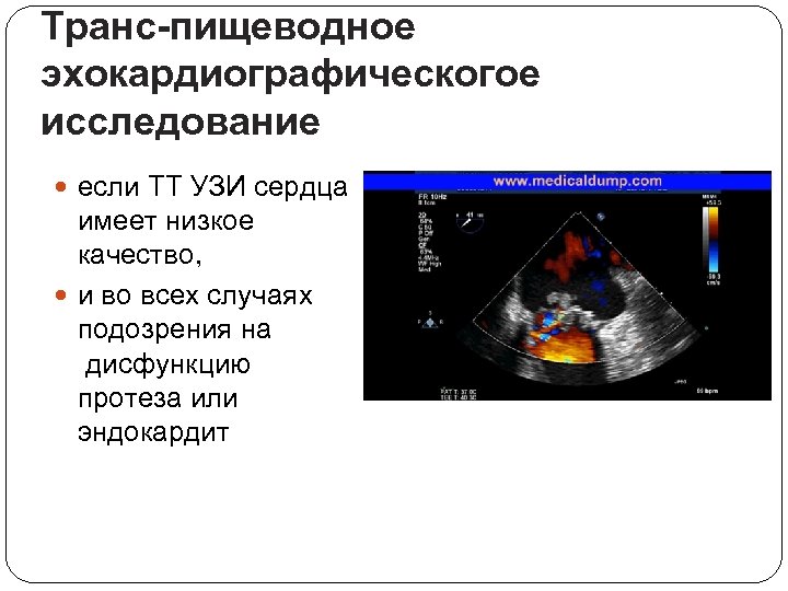 Транс-пищеводное эхокардиографическогое исследование если TT УЗИ сердца имеет низкое качество, и во всех случаях