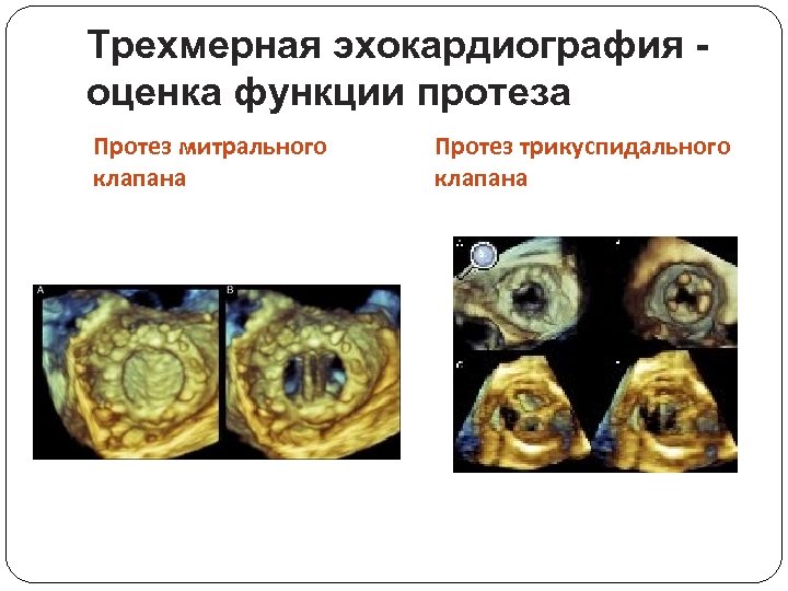Трехмерная эхокардиография оценка функции протеза Протез митрального клапана Протез трикуспидального клапана 