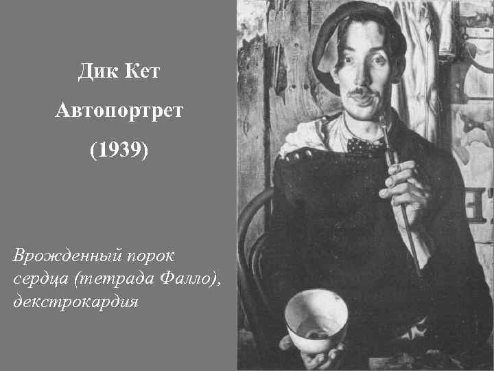 Дик Кет Автопортрет (1939) Врожденный порок сердца (тетрада Фалло), декстрокардия 
