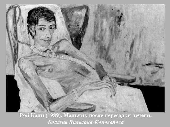 Рой Калн (1989). Мальчик после пересадки печени. Болезнь Вильсона-Коновалова 