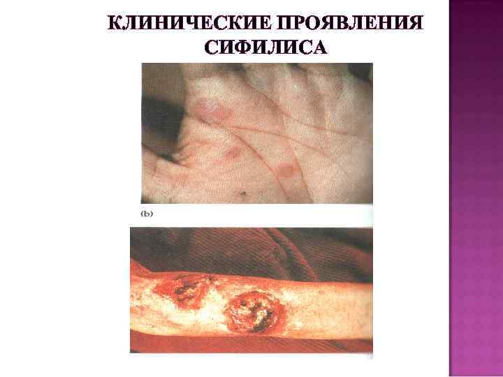 КЛИНИЧЕСКИЕ ПРОЯВЛЕНИЯ СИФИЛИСА 